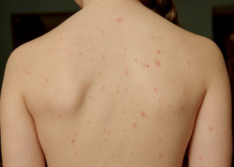 Close-up of naked body of child with pimples of chicken pox. pimples on the body of child with chickenpox