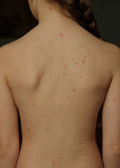 Close-up of naked body of child with pimples of chicken pox. pimples on the body of child with chickenpox
