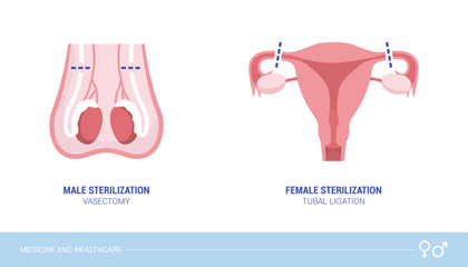 Male and female sterilization