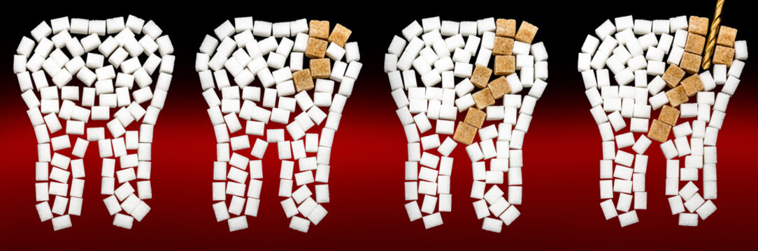 Durch Zucker entstehender Karies am Zahn dargestellt mit Z&auml;hnen aus W&uuml;rfelzucker