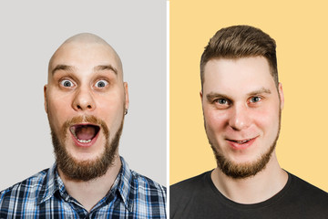 Change one guy before after: bald, with a haircut and styling, with long hair on background. Concept for a barber shop, and medicine: the problem of hair loss, alopecia, transplantation