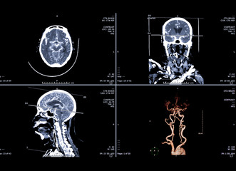 Computed tomography angiography or CTA brain  3D Rendering image , coronal ,sagittal and axial plane  for finding Stroke and aneurysm  disease .