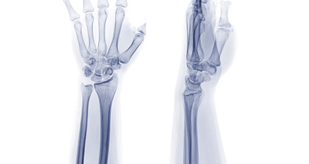 X-ray image of left wrist joint Ap and Lateral view. rheumatoid arthritis concept.