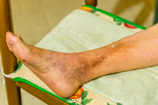 Phlebitis Images – Browse 963 Stock Photos, Vectors, and Video | Adobe Stock