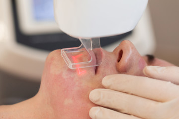 Close-up of Laser action during rejuvenating facial face treatment at cosmetology clinic. Young...