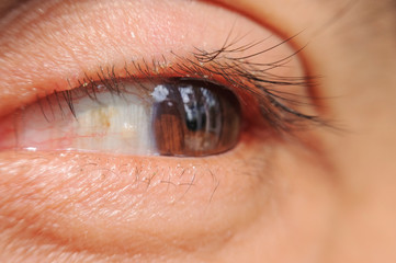 Obraz premium close up Blepharitis or Eyelid inflammation healthy eyes concept