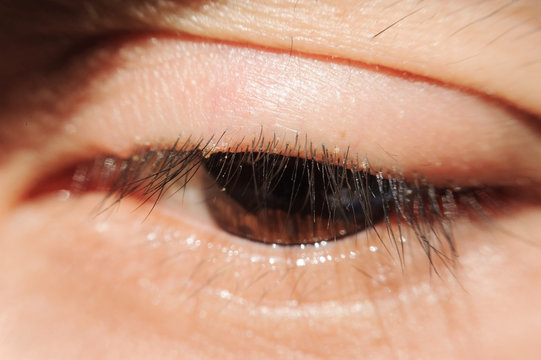 close up Blepharitis or Eyelid inflammation eyes healthy concept