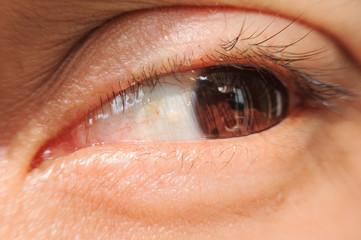 Obraz premium close up Blepharitis or Eyelid inflammation eyes healthy concept