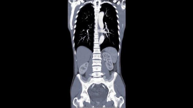 CTA abdominal aorta Coronal plane front to back. 
