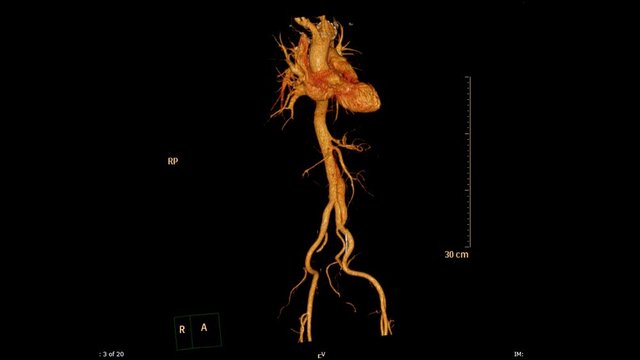 CT Angiography or CTA abdominal aorta 3D rendering image turn around on the screen 3D production from CT scanner. medical technology concept.