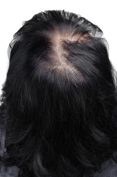 Women hair after using cosmetic powder to thicken hair. Photo before.
