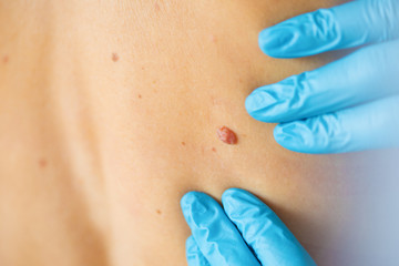 Dermatologist examine birthmark on patient's skin