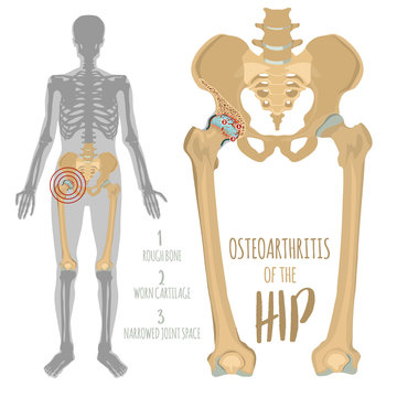 Hip Osteoarthritis Image