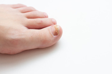 foot with nail fungus © epovdima