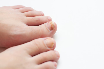 toenails with fungus