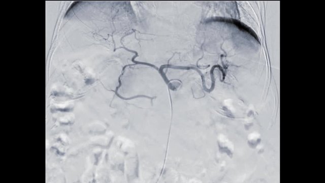 transcatheter oily chemoembolization or TOCE  with Fluoroscopic guided peripheral intervention selective splenic artery  on the monitor.