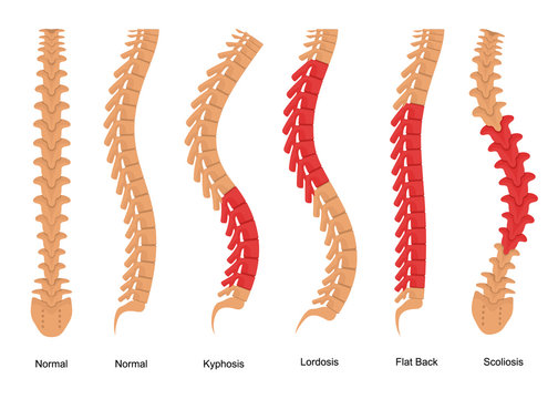 Lordosis Photos Royalty Free Images Graphics Vectors Videos Adobe Stock
