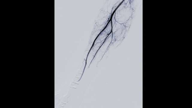 fluoroscopic image of Vessel in the arm or angioplasty of brachial artery on screen in intervention radiology room.