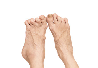 Rheumatoid arthritis in the feet.