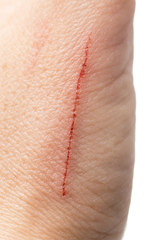 a scratch on the arm