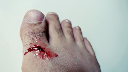  Toe is wound due to an accident without being careful, The toes were wounded with blood flowing, close up part of human body got accident concept 