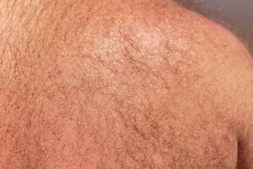 Fototapeta premium Hair grows on the back of a man