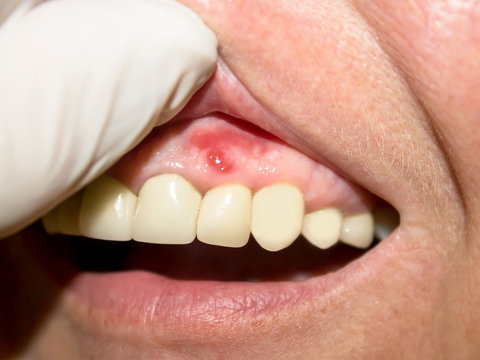 Periodontitis. Inflammatory process in the gum area. The doctor examines the oral cavity. Preliminary examination of the dentist.