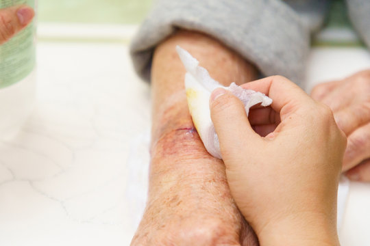 Close up old woman hand, upper limb or arm to the wounded waiting for nurse treatment on wound dressing a bloody and brine of patient.