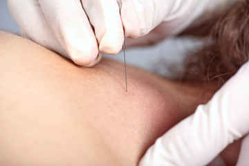 Chiropractor doing dry needling, closeup of a needle and hands. Physiotherapist, osteopath, manual therapy, acupressure. Acupuncture, alternative medicine.