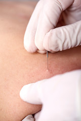 Chiropractor doing dry needling, closeup of a needle and hands. Physiotherapist, osteopath, manual therapy, acupressure. Acupuncture, alternative medicine.