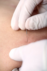 Chiropractor doing dry needling, closeup of a needle and hands. Physiotherapist, osteopath, manual therapy, acupressure. Acupuncture, alternative medicine.