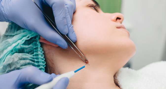 procedure removing mole. radio wave electrocoagulation method