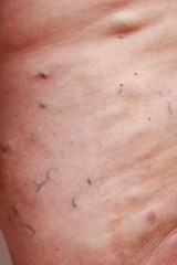 Fototapeta premium The varicose veins