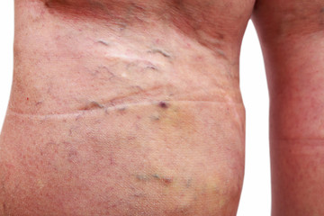 Fototapeta premium The varicose veins