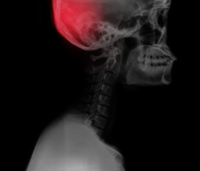 X Ray show red area for brain pain