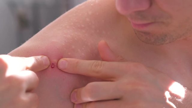Big red pimple on a man's shoulder close-up view. Man squeezes a pimple with blood by hand.