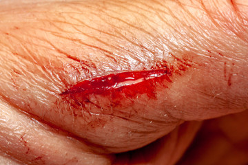 One photo of a series of photos taken of a fresh bleeding cut development over a priod of 90 minutes