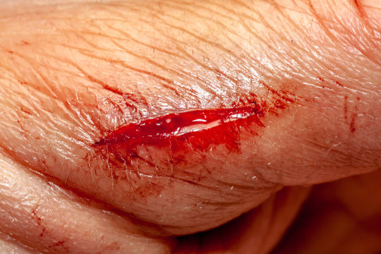 One photo of a series of photos taken of a fresh bleeding cut development over a priod of 90 minutes
