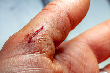 One photo of a series of photos taken of a fresh bleeding cut development over a priod of 90 minutes