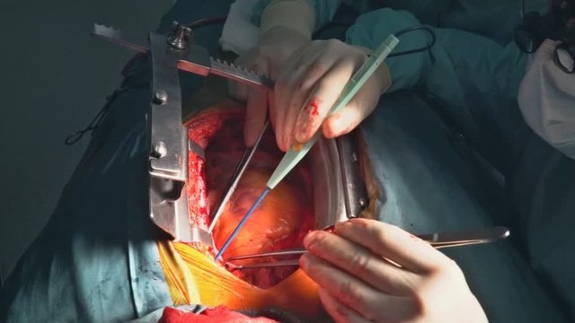 A surgeon performs coronary artery bypass grafting open heart surgery artery