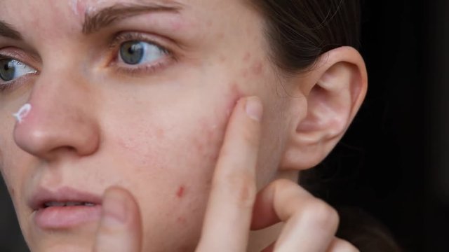 Beautiful girl with not smooth skin smears pimples on her face