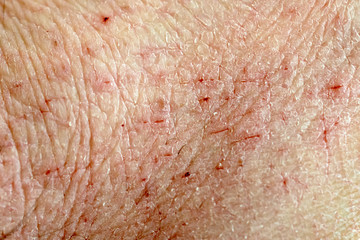 Fototapeta premium Damaged dry human skin texture macro shot