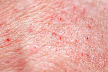 Damaged dry human skin texture macro shot