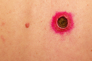 Fototapeta premium the wound after removal of moles on a woman's back is smeared with fukortsin