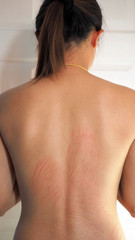 Allergic rash dermatitis eczema on skin. Urticaria.