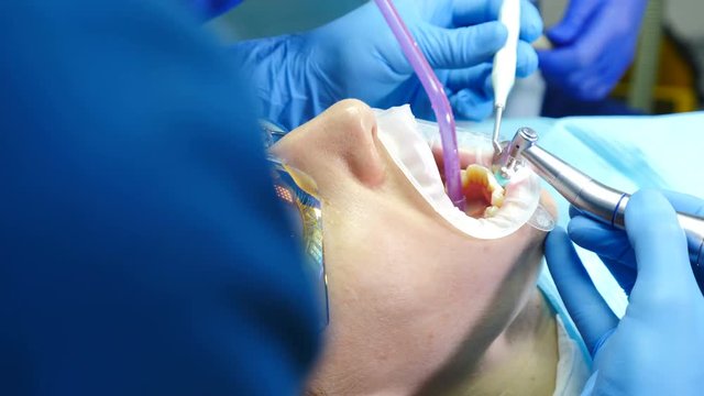 Dental clinic concept. Closeup shot of dentist treating female patient with an expander in mouth. In Modern Dental Office. Orthodontist works with an assistant. 4k