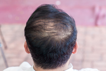 Close up hair loss, thinning hair and scalp issue. hair loss treatment.head with loss symptoms....