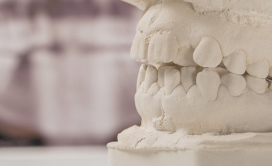 Dental casting gypsum model of human jaws with panoramic dental x-ray . Crooked teeth and distal bite. Shots were made before treatment with braces. - obrazy, fototapety, plakaty
