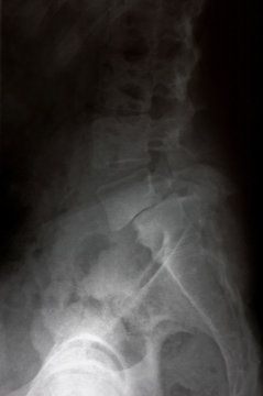 X-ray picture - backbone