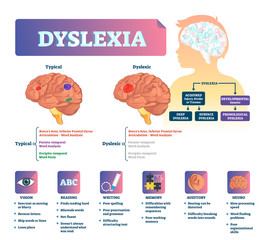 Dyslexia vector illustration. Labeled medical brain illness problem scheme. - obrazy, fototapety, plakaty
